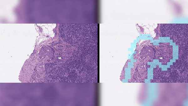 Google Details The Deepmind Ai Cancer Detection Study Gizbot News